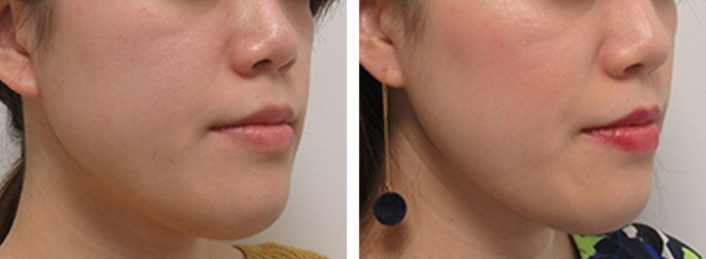 TAC式 ツヤ肌コラーゲンリフト®/ボトックス注射：その他の症例写真 施術前後 １ヵ月