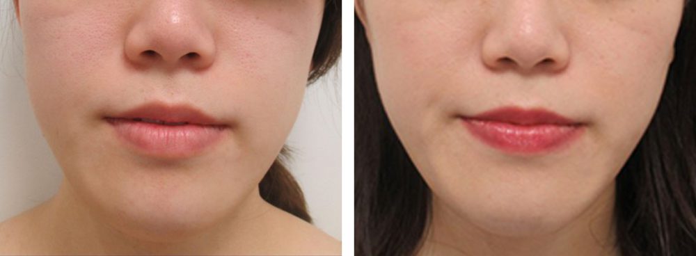 TAC式 ツヤ肌コラーゲンリフト®/ボトックス注射：その他の症例写真 施術前後 ２週間