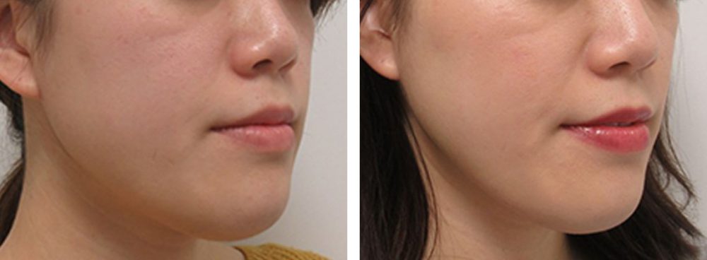 TAC式 ツヤ肌コラーゲンリフト®/ボトックス注射：その他の症例写真 施術前後 ２週間