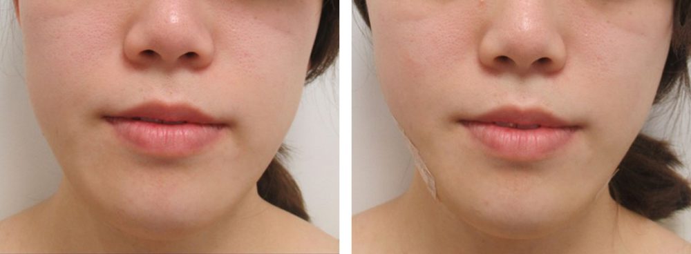 TAC式 ツヤ肌コラーゲンリフト®/ボトックス注射：その他の症例写真 施術前後 直後