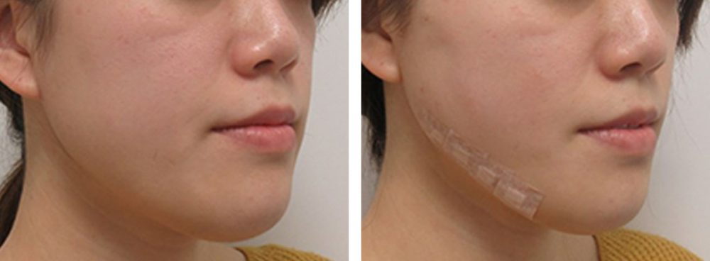 TAC式 ツヤ肌コラーゲンリフト®/ボトックス注射：その他の症例写真 施術前後 直後