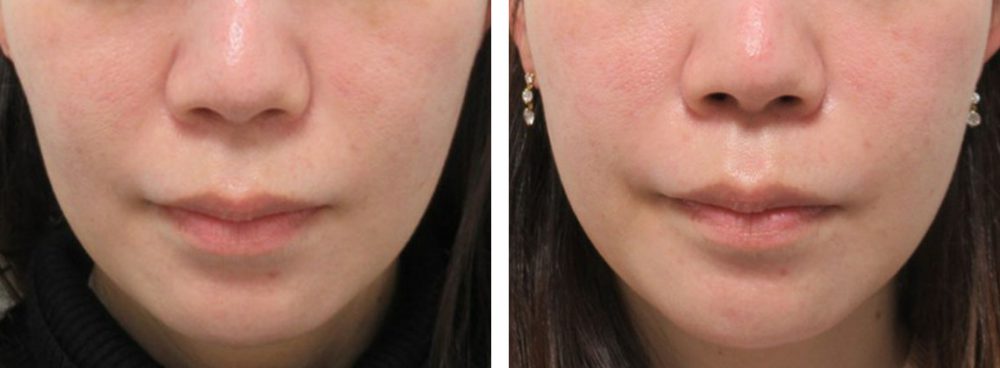 TAC式 ツヤ肌コラーゲンリフト®の症例写真 施術前後 １０日