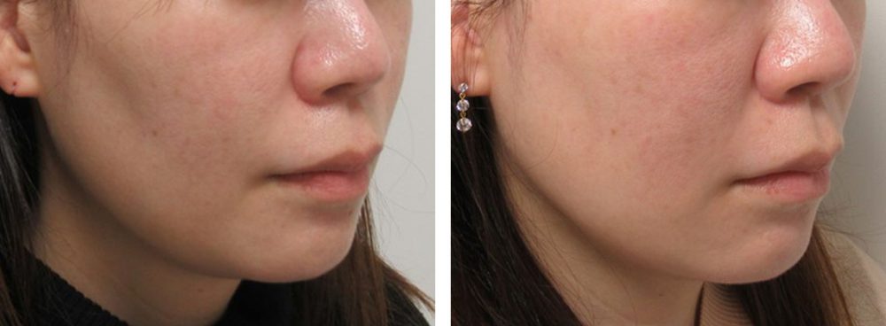 TAC式 ツヤ肌コラーゲンリフト®の症例写真 施術前後 １０日