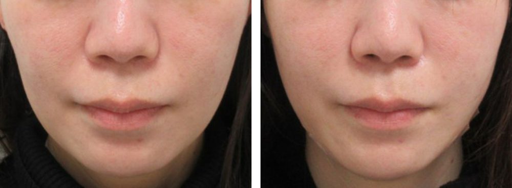 TAC式 ツヤ肌コラーゲンリフト®の症例写真 施術前後 直後