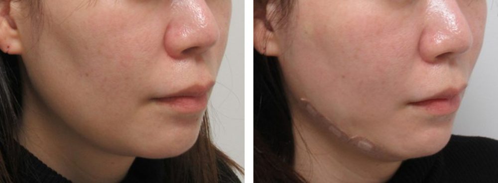 TAC式 ツヤ肌コラーゲンリフト®の症例写真 施術前後 直後