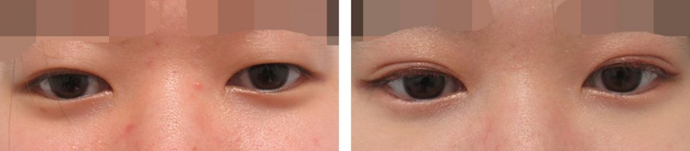 黒目の露出が多いと目が大きく見えます