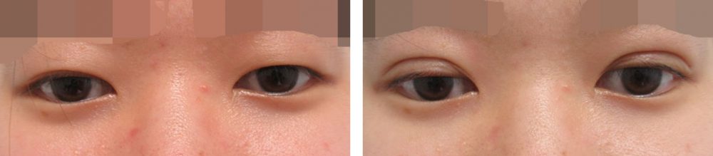 二重埋没法の症例写真 施術前後 直後