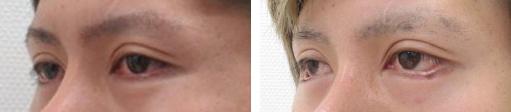 グラマラスライン（タレ目形成）の症例写真 施術前後 １ヵ月と３週間