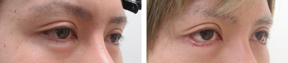 グラマラスライン（タレ目形成）の症例写真 施術前後 １ヵ月と３週間