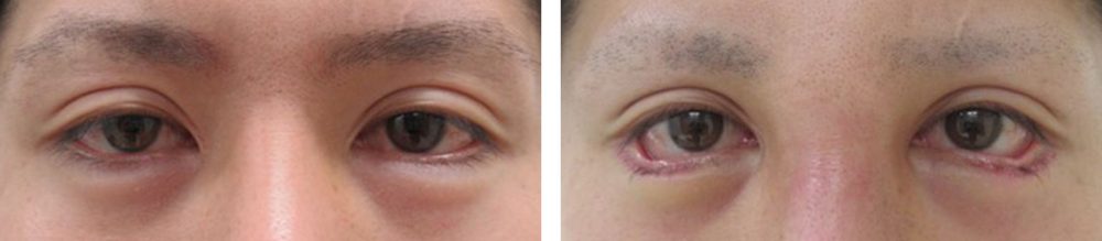 グラマラスライン（タレ目形成）の症例写真 施術前後 １週間