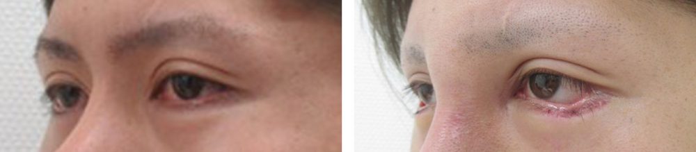 グラマラスライン（タレ目形成）の症例写真 施術前後 １週間