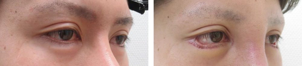 グラマラスライン（タレ目形成）の症例写真 施術前後 １週間