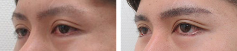 グラマラスライン（タレ目形成）の症例写真 施術前後 ３ヵ月と２週間