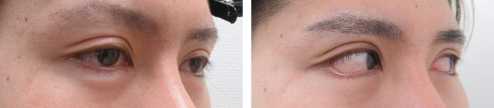 グラマラスライン（タレ目形成）の症例写真 施術前後 ３ヵ月と２週間