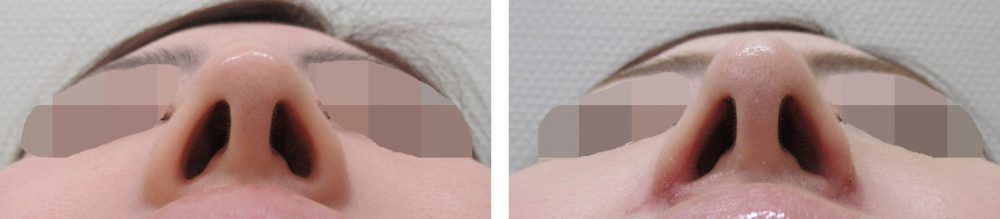 鼻翼と鼻尖の改善