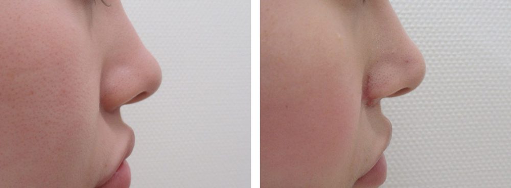 TAC式 鼻翼縮小術（小鼻縮小）/鼻孔縁挙上術/鼻尖形成・鼻尖縮小の症例写真 施術前後 １０日