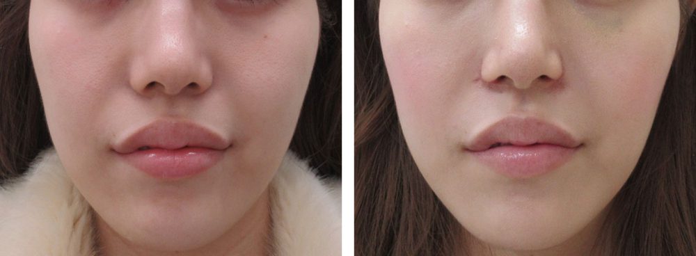 TAC式 鼻翼縮小術（小鼻縮小）/鼻孔縁挙上術/鼻尖形成・鼻尖縮小の症例写真 施術前後 １０日