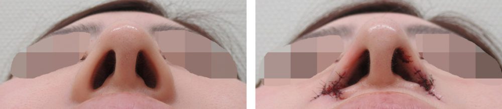 TAC式 鼻翼縮小術（小鼻縮小）/鼻孔縁挙上術/鼻尖形成・鼻尖縮小の症例写真 施術前後 直後