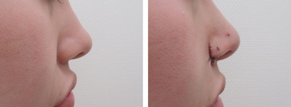 TAC式 鼻翼縮小術（小鼻縮小）/鼻孔縁挙上術/鼻尖形成・鼻尖縮小の症例写真 施術前後 直後