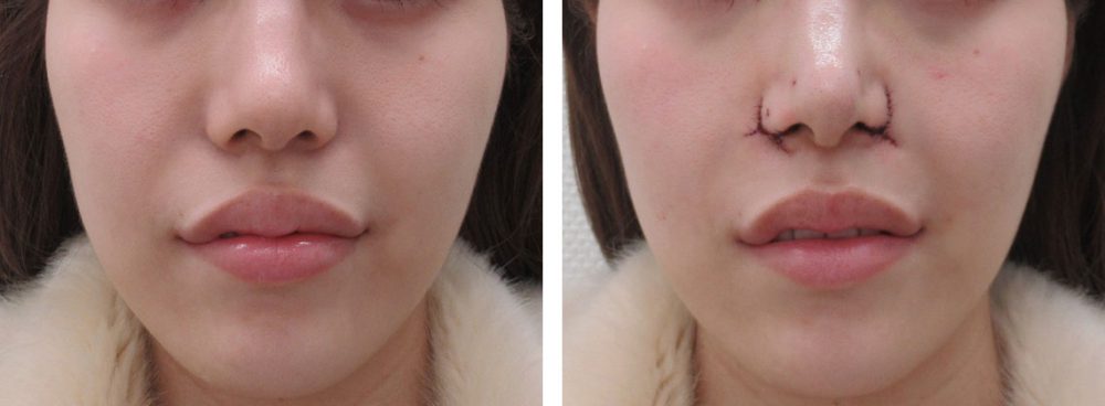 TAC式 鼻翼縮小術（小鼻縮小）/鼻孔縁挙上術/鼻尖形成・鼻尖縮小の症例写真 施術前後 直後