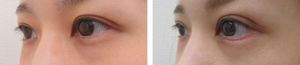 二重埋没法/グラマラスライン（タレ目形成）の症例写真 施術前後 １ヵ月