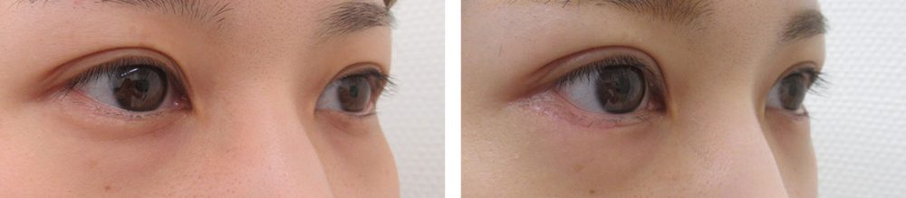 二重埋没法/グラマラスライン（タレ目形成）の症例写真 施術前後 １ヵ月