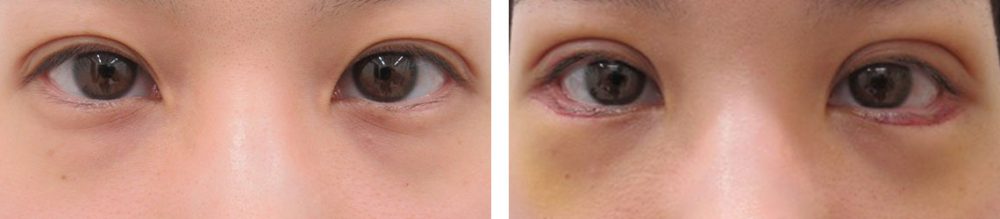 二重埋没法/グラマラスライン（タレ目形成）の症例写真 施術前後 １週間