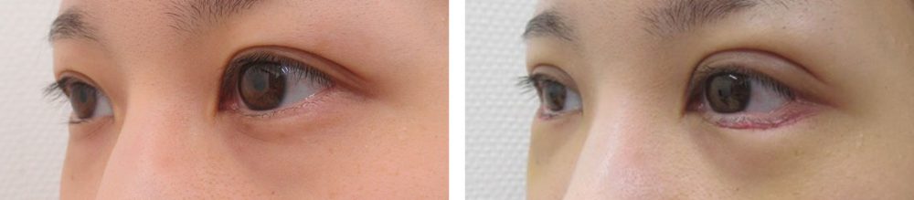 二重埋没法/グラマラスライン（タレ目形成）の症例写真 施術前後 １週間