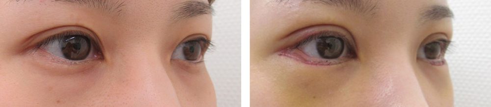 二重埋没法/グラマラスライン（タレ目形成）の症例写真 施術前後 １週間