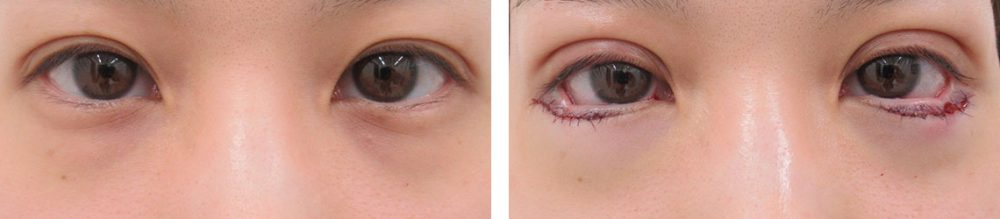 二重埋没法/グラマラスライン（タレ目形成）の症例写真 施術前後 直後