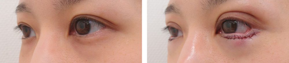 二重埋没法/グラマラスライン（タレ目形成）の症例写真 施術前後 直後