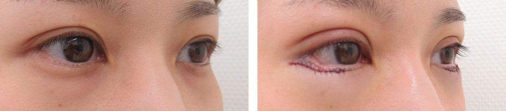 二重埋没法/グラマラスライン（タレ目形成）の症例写真 施術前後 直後