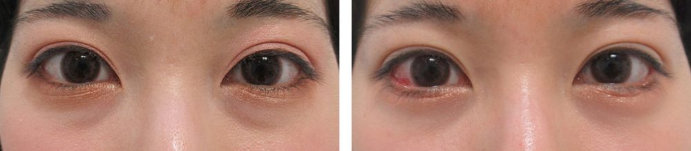 タレ目と目の下のクマ取り