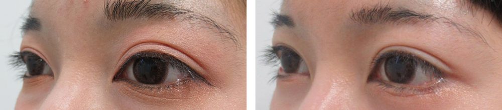 グラマラスライン（タレ目形成）/下眼瞼脱脂術（目の下のたるみ取り・目の下の脂肪ふくらみ取り）の症例写真 施術前後 １ヵ月