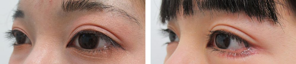 グラマラスライン（タレ目形成）/下眼瞼脱脂術（目の下のたるみ取り・目の下の脂肪ふくらみ取り）の症例写真 施術前後 １週間