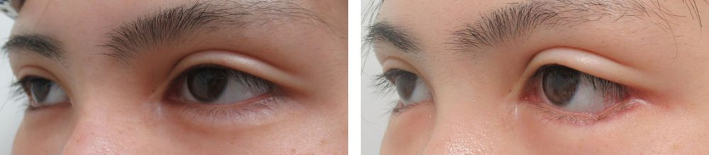 グラマラスライン（タレ目形成）/目尻切開術の症例写真 施術前後 １ヵ月