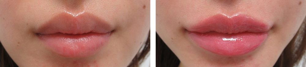 ボリュームのあるリップ