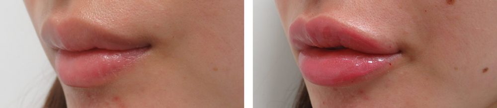 の症例写真 施術前後 直後