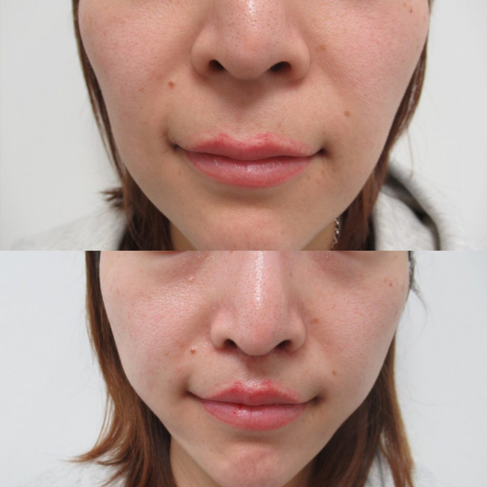 口角リフト（口角挙上）、TAC式ツヤ肌コラーゲンリフト、TAC式人中短縮術の一か月経過です。