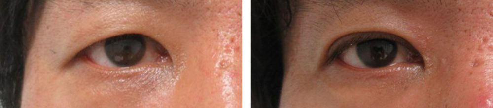 埋没二重術で小さな目を大きな目に