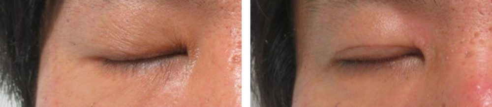 二重埋没法の症例写真 施術前後 ２ヵ月