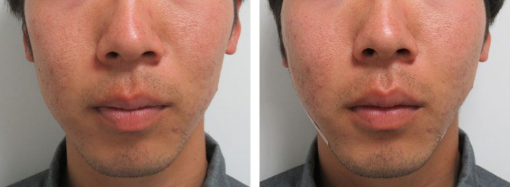 TAC式 ツヤ肌コラーゲンリフト®/ボトックス注射:その他の症例写真 施術前後 直後