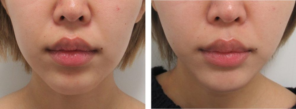 バッカルファット除去でシュッとした輪郭