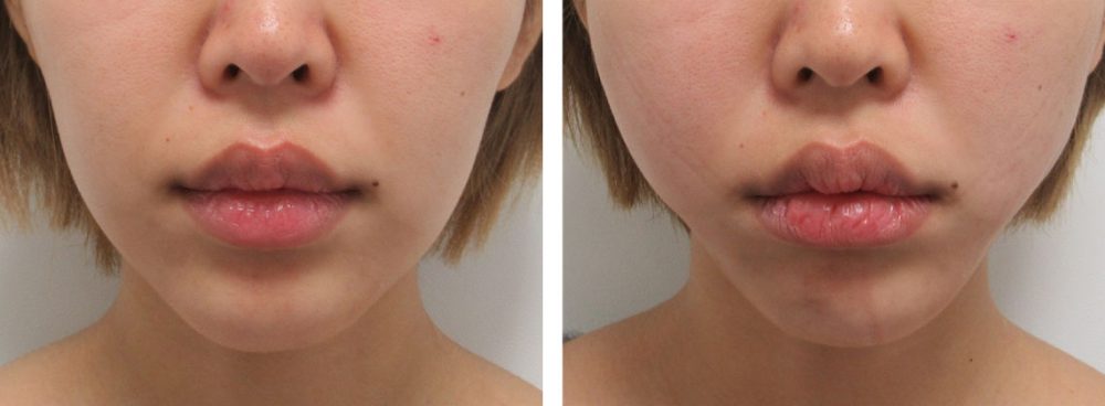 バッカルファット除去/TAC式 ツヤ肌コラーゲンリフト®/ボトックス注射：その他の症例写真 施術前後 直後