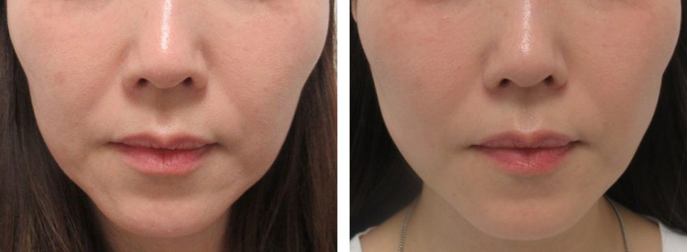 TAC式 ツヤ肌コラーゲンリフト®の症例写真 施術前後 １０日