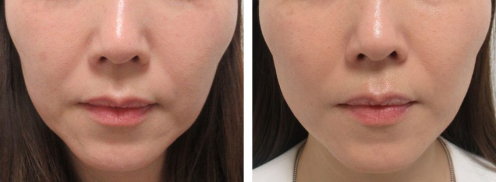 糸リフトで輪郭の改善