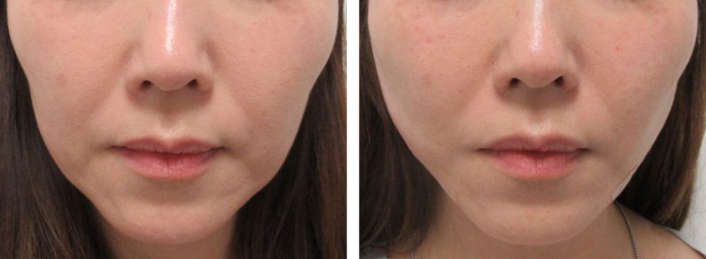 TAC式 ツヤ肌コラーゲンリフト®の症例写真 施術前後 直後