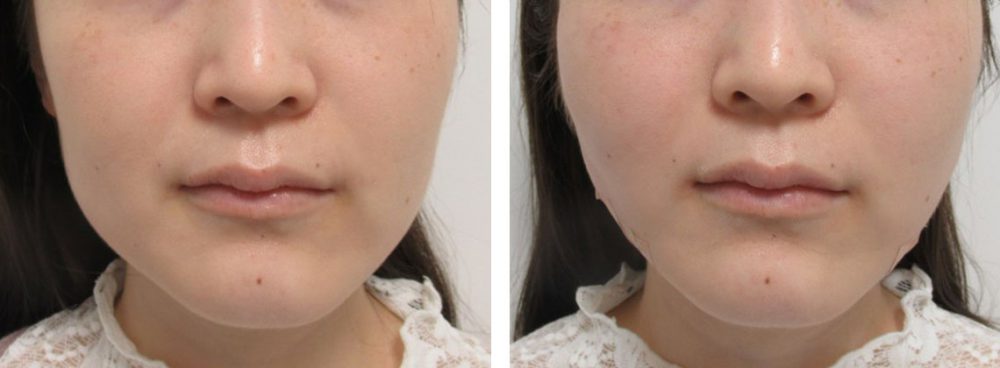 コラーゲンリフトとボトックスで輪郭の修正