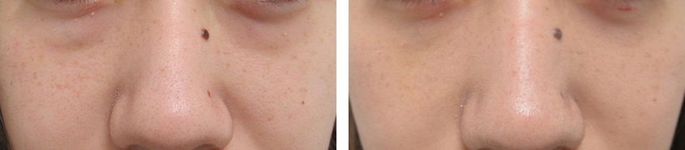 目の下の膨らみを取って疲れ顔の印象を変える