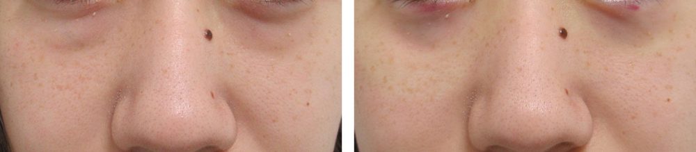 下眼瞼脱脂術（目の下のたるみ取り・目の下の脂肪ふくらみ取り）の症例写真 施術前後 直後